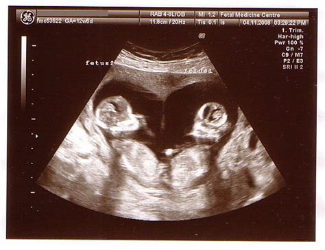 Twins 12 Week Scan Heart Shaped Twins Ultrasound 12 Week Scan