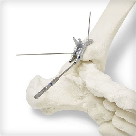 Ankle Fracture Plating System Unite Foot And Ankle