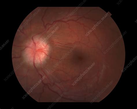 Papilledema Stock Image C0271182 Science Photo Library