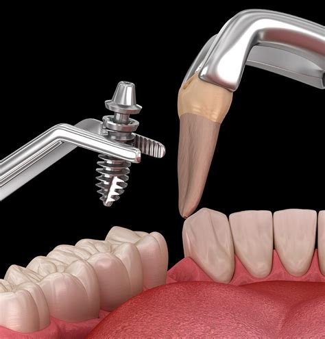 Implantes Dentales Inmediatos Clínica Noguerol