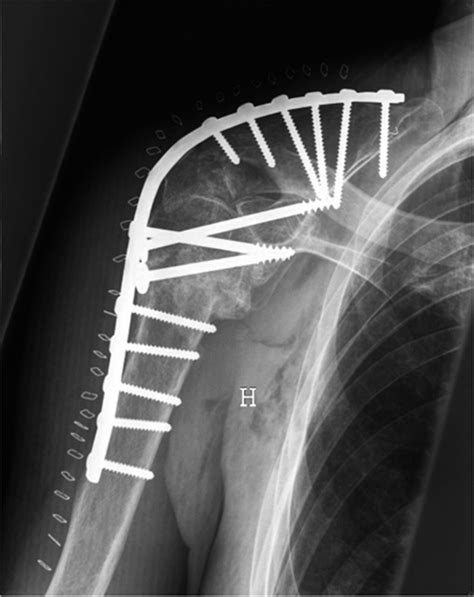 Shoulder Arthrodesis With Stable Plate Fixation Download Scientific