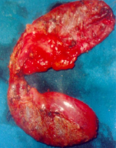 Multimodality Management of Gallbladder and Biliary Tract Disease and
