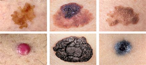 Friends Noticed This Mole While We Were Out Does It Look Like Melanoma