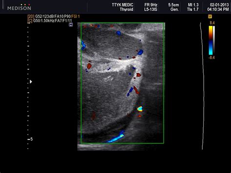 Vietnamese Medic Ultrasound Case 165 A Subcutaneous Wall Mass Dr