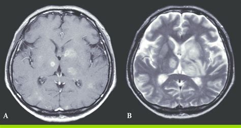 Toxoplasmosis Brain Mri