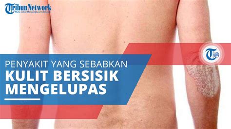 Lapisan kering, tipis, dan berwarna putih keperakan yang menutupi plak. Psoriasis, Peradangan Kulit Ditandai Ruam Merah, Kulit ...