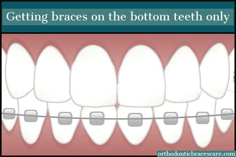can you get braces on bottom teeth only orthodontic braces care