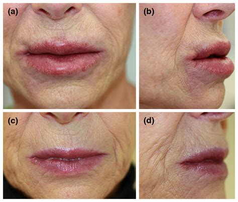 Foreign Body Granuloma Lip Filler