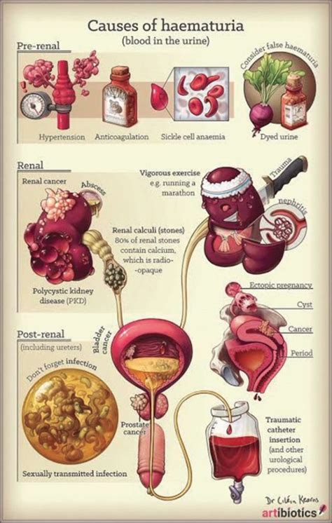 Hematuria Blood In The Urine Urology Clinic In Malaysia