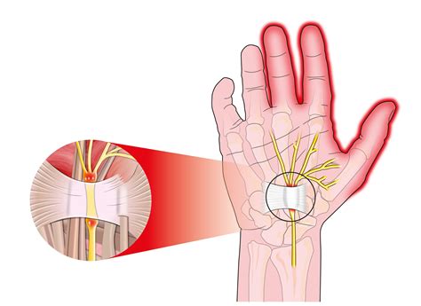 Carpal Tunnel Syndrome Raleigh Hand Surgery Joseph J Schreiber Md