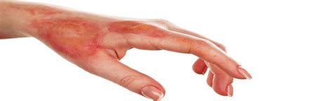 Burn Injuries Attorneys Ventura The King Law Firm