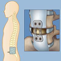 Anterior Lumbar Interbody Fusion Alif Weill Cornell Brain And Spine Center