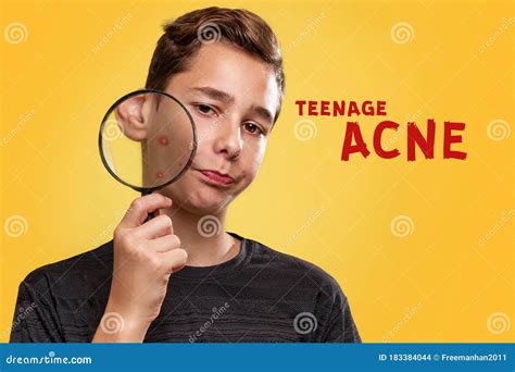 The Concept Of Teenage Acne A Teenage Boy With A Distressed Face
