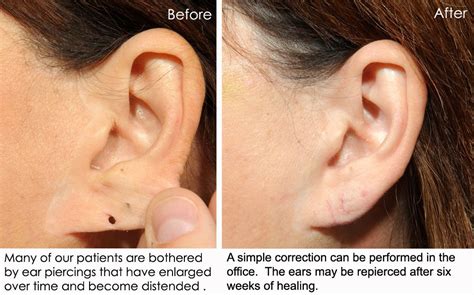 Earlobe Repair Mole Removal And Misc Before And After Gallery Dr