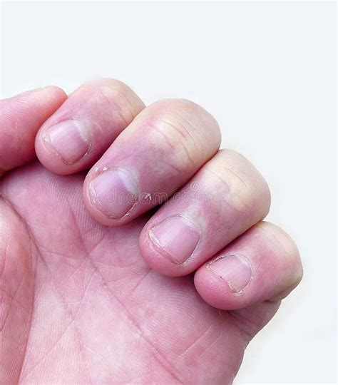 Skin Peeling On Finger Nails Vitamin C Deficiency And Nail Skin
