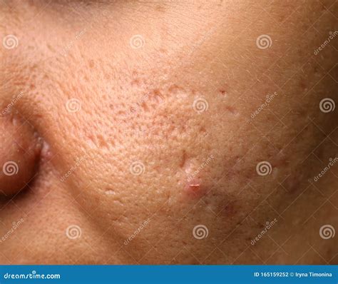 Inflamed Skin On The Face Acne Pimples On The Skin Scars And Peeling