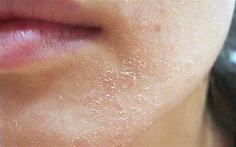 Dry Skin Causes Symptoms And Natural Treatment