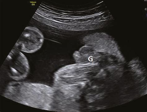 Ambiguous Genitalia Ultrasound