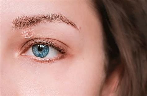 Dry Eyelids Causes And Remedies According To 41 Off