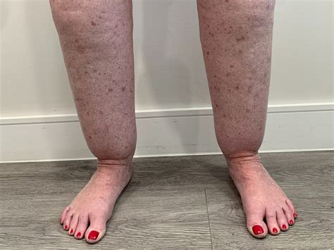 What You Need To Know About Lipedema Tactile Medical