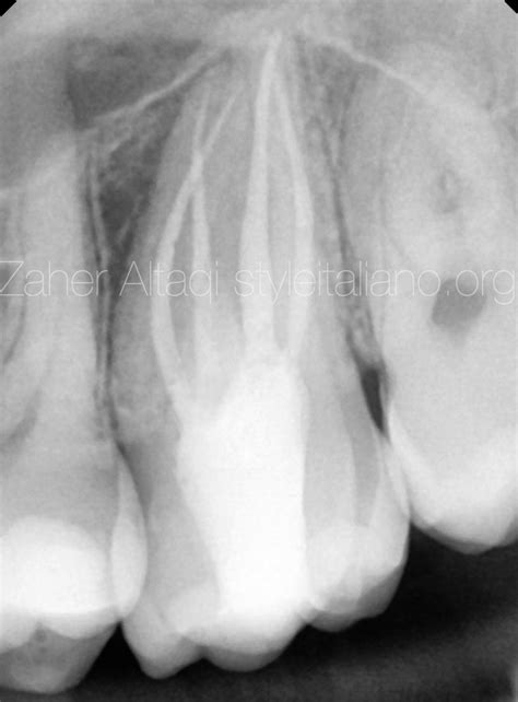 Unusual Anatomy In Upper Second Molar Style Italiano Endodontics