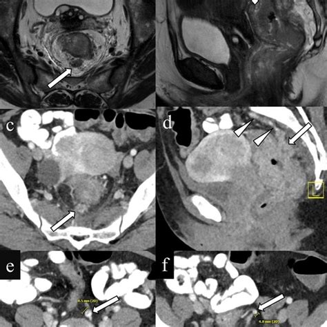 Extramural Venous Invasion On Histopathology A The Tumor Cells