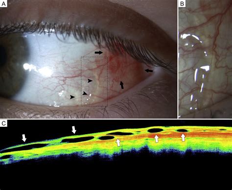 Conjunctival Lymphangiectasia In A Pediatric Patient With