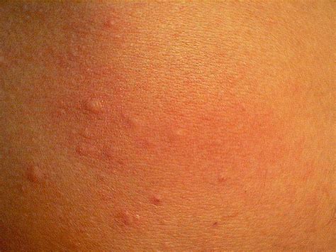 Cholinergic Urticaria Causes Picture Symptoms And Treatment