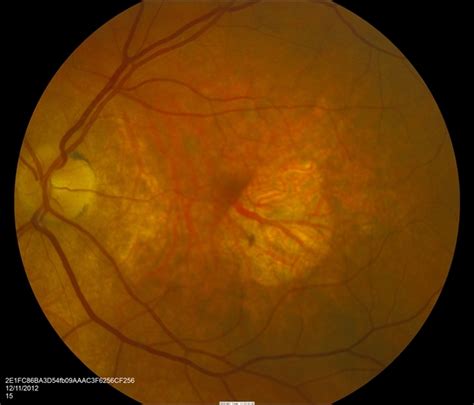 Age Related Macular Degeneration Geographic Atrophy Retina Image Bank