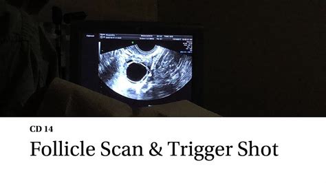 Ttc Baby 1 Follicle Scan And Trigger Shot 💉 Youtube