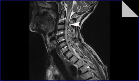 Sagittal T2 Weighted Mri Of His Cervical Spine Shows An Open I