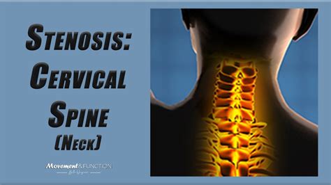 Cervical Spine Stenosis Best Exercises To Decrease Pain And Other