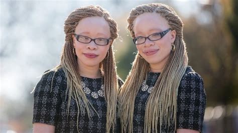 These Albino Twins Are Not Allowing Their Condition Hold Them Back From Making Waves In The