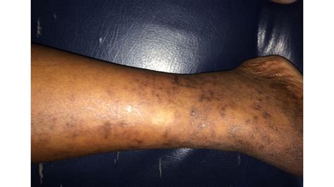 Mottled Skin Livedo Reticularis Causes Signs And Treatment