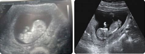 11 Weeks Pregnant Belly And Ultrasound Pictures Symptoms And Fetal