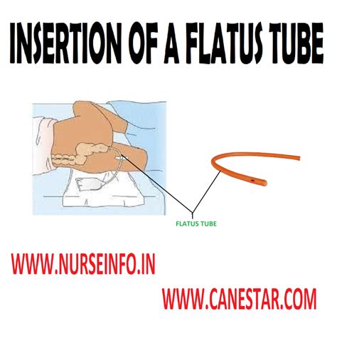 Insertion Of Flatus Or Rectal Tube Overview