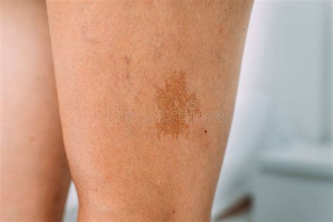 Large Birthmark On The Leg Of A Caucasian Person Stock Photo Image Of