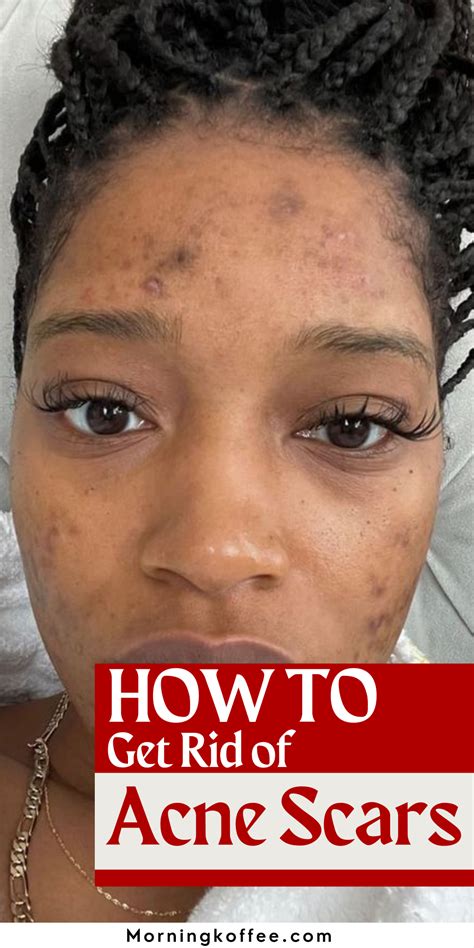 Acne Pit Scars Cystic Acne Scars Pimple Scars Home Remedies For Acne