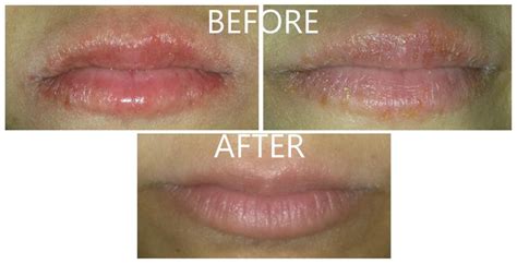 Accutane Users Amazing Cure For Cracked And Chapped Lips Page 2