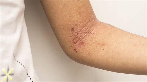 Pele Vermelha Inflamada E Que Coça Saiba Como Lidar Com A Dermatite