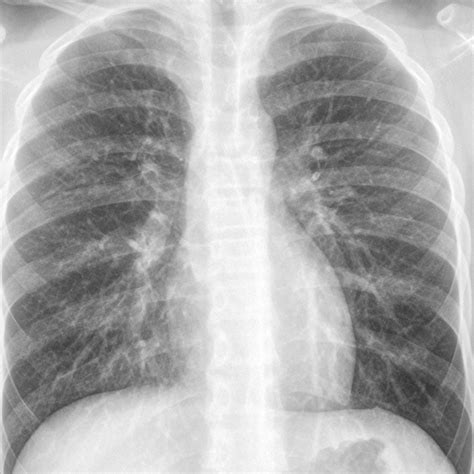Pneumonia Chest X Ray Kaggle