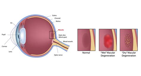 Age Related Macular Degeneration Dr Brighu Swamy Ophthalmic Surgeon