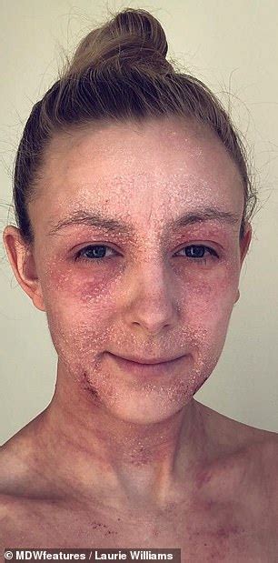 Eczema Sufferer Endures Flaking Skin Since Ditching Her Steroid Creams Best Health Tale
