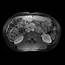 Metastatic Carcinoid Tumor To The Liver  Body MR Case Studies CTisus