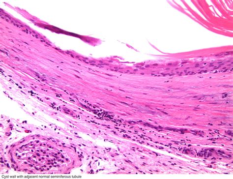 Pathology Outlines Teratoma Epidermoid Cyst