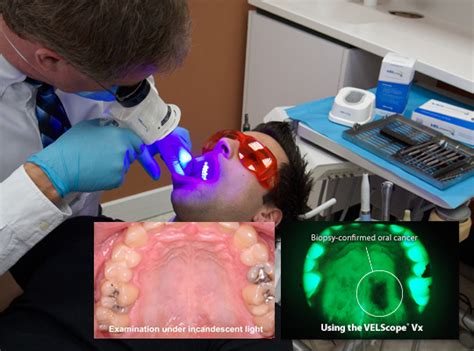 Velscope Oral Cancer Screening Silver Smile Dental
