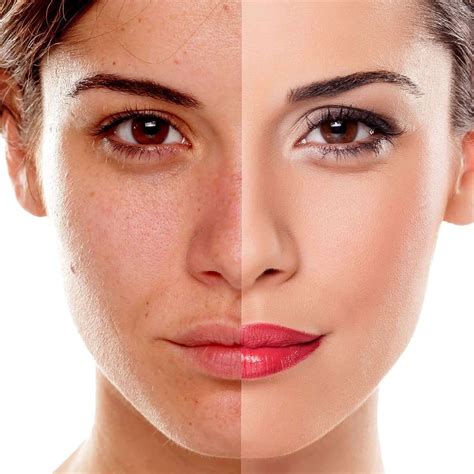 Oily Skin Type • Treatments And Skincare • Nascent Skin Clinic