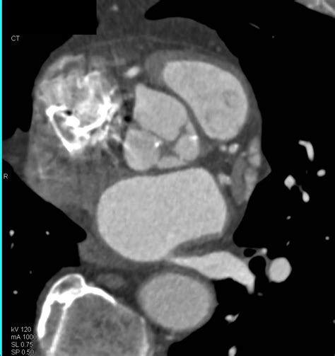 Aortic Valve Calcification Cardiac Case Studies Ctisus Ct Scanning