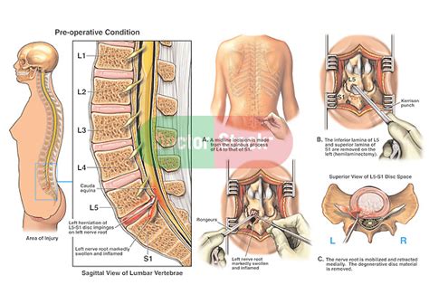 L S Disc Herniation With Hemilaminectomy And Discectomy Procedure