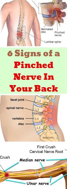 Here Are 6 Signs Of A Pinched Nerve In Your Back Famous Comedy Humor